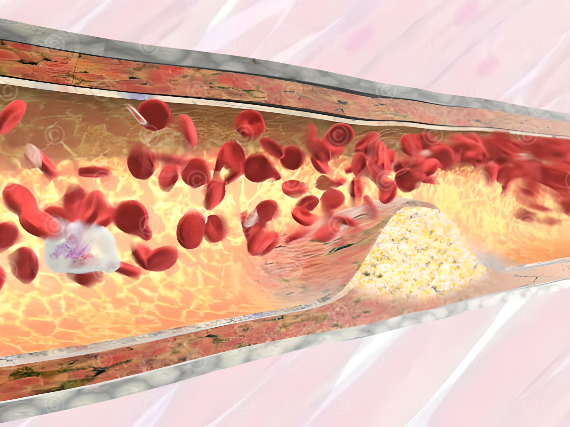 Arterial plaque Arterial plaque