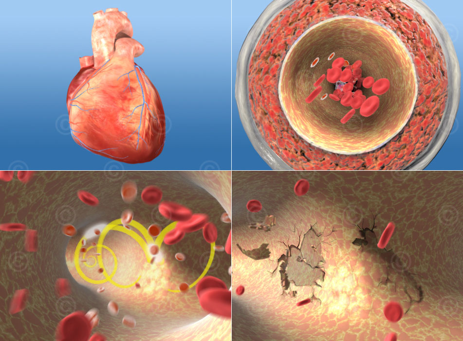 arterial hypertension