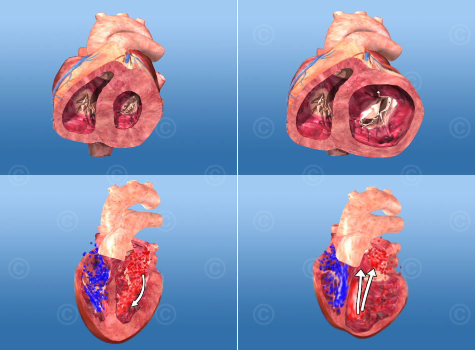 Mitral valve insufficiency