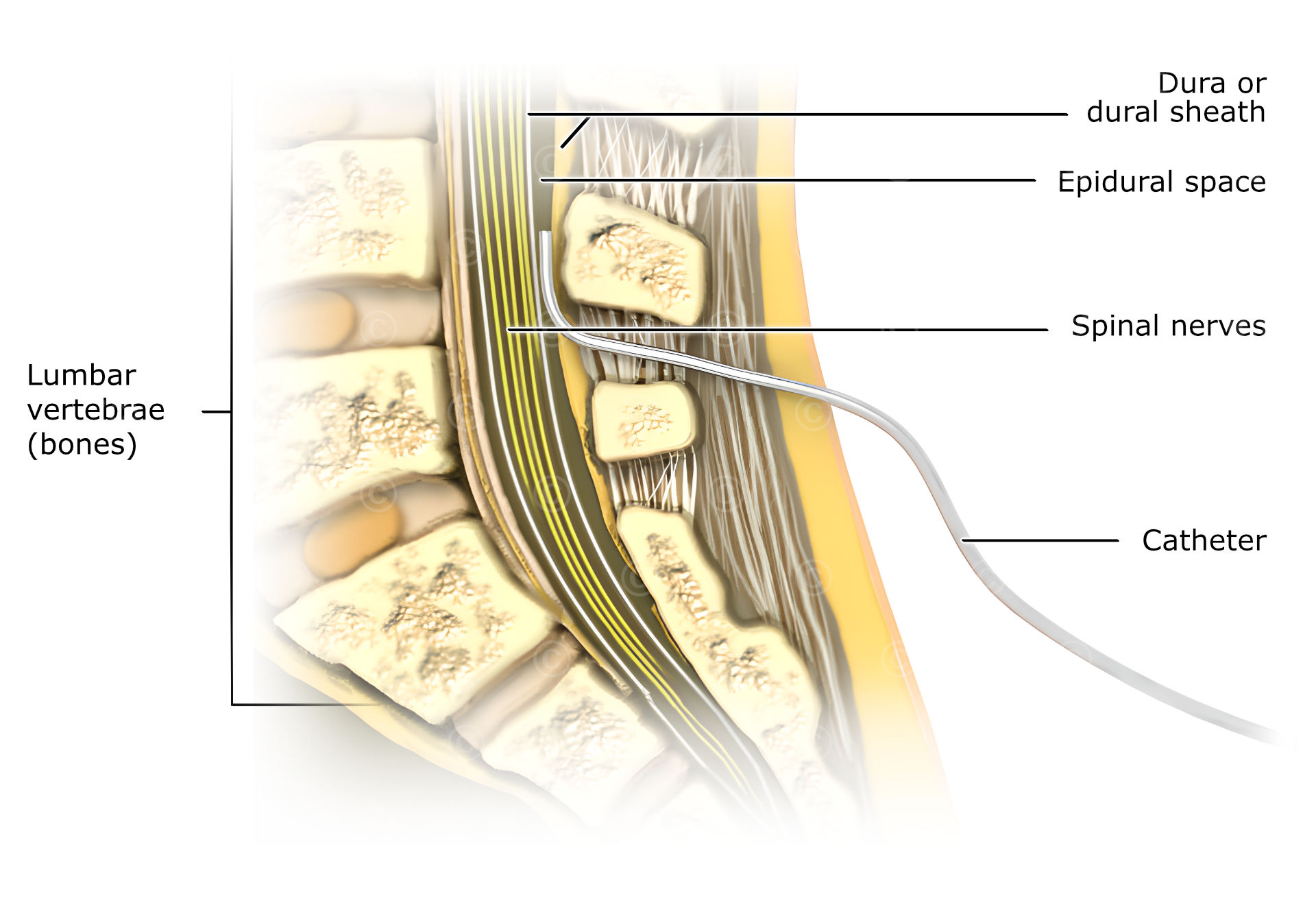 Peridural anesthesia