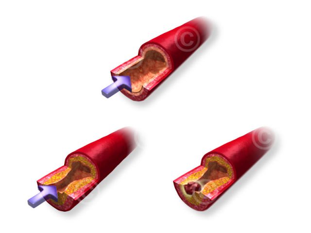 Illustration stenosis