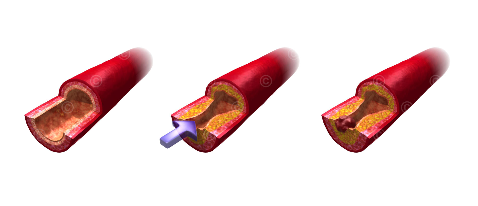 Stenosis artery