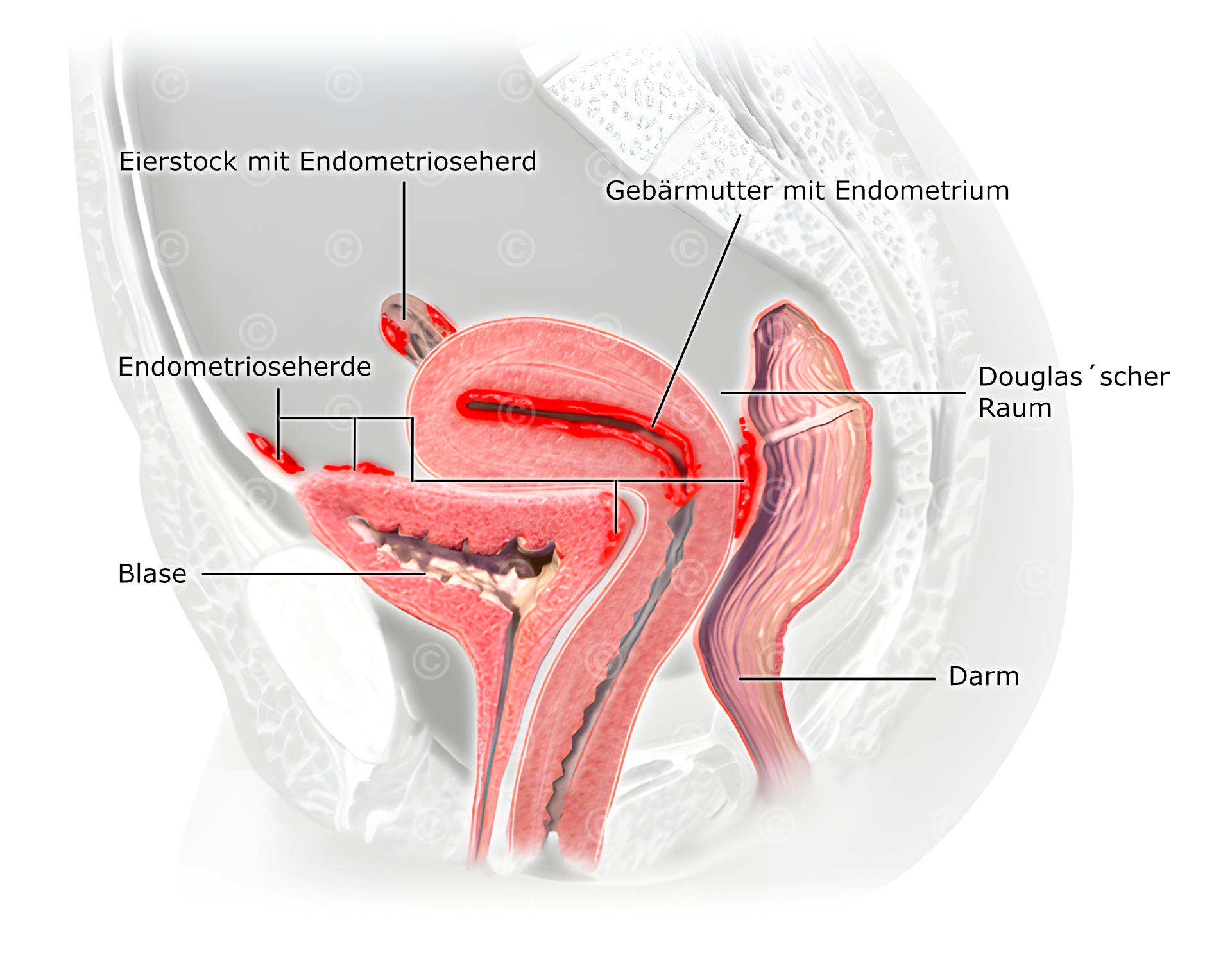 Endometriose