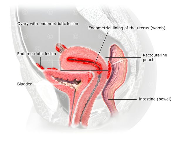 Illustration areas endometriosis