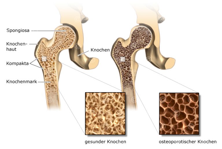 Illustration Osteoporose - MedicalGraphics