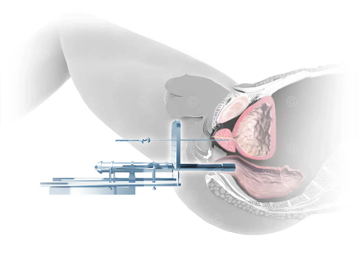 Brachytherapy