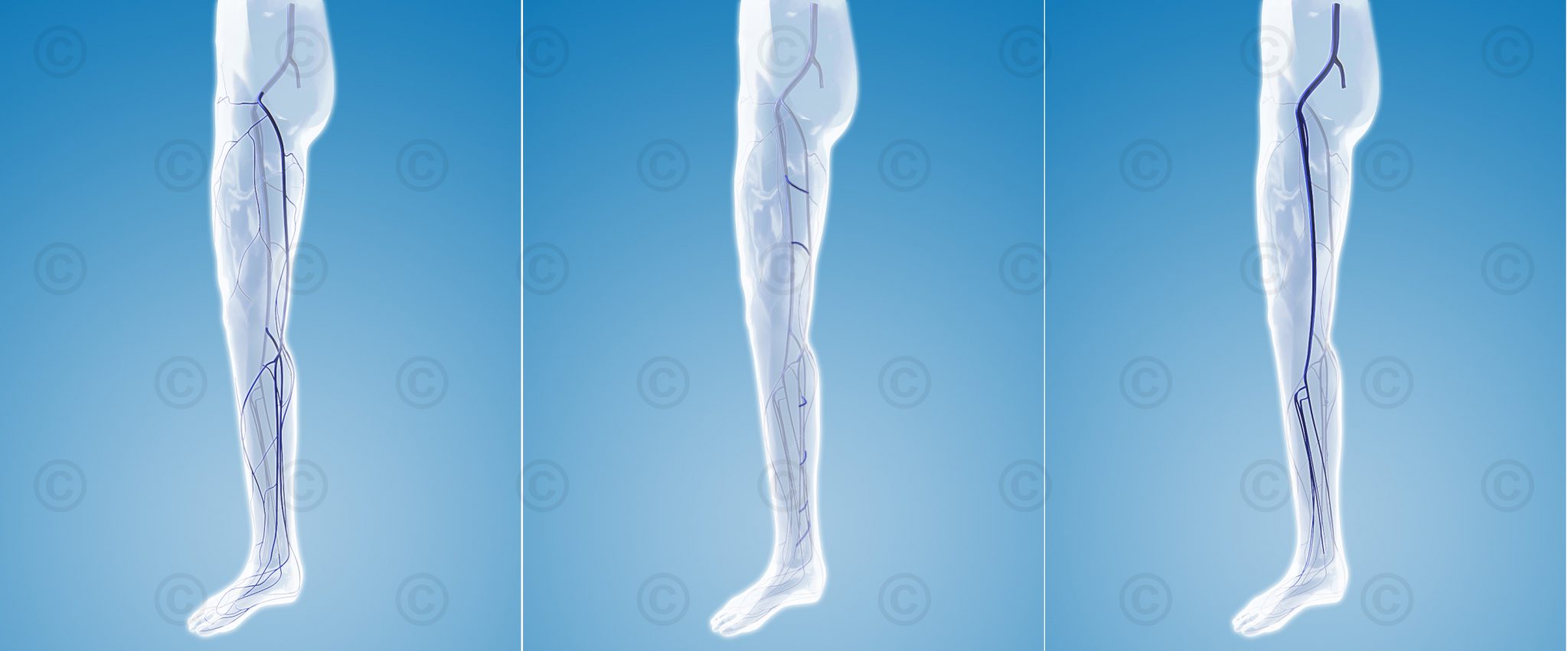 Animation leg veins MedicalGraphics