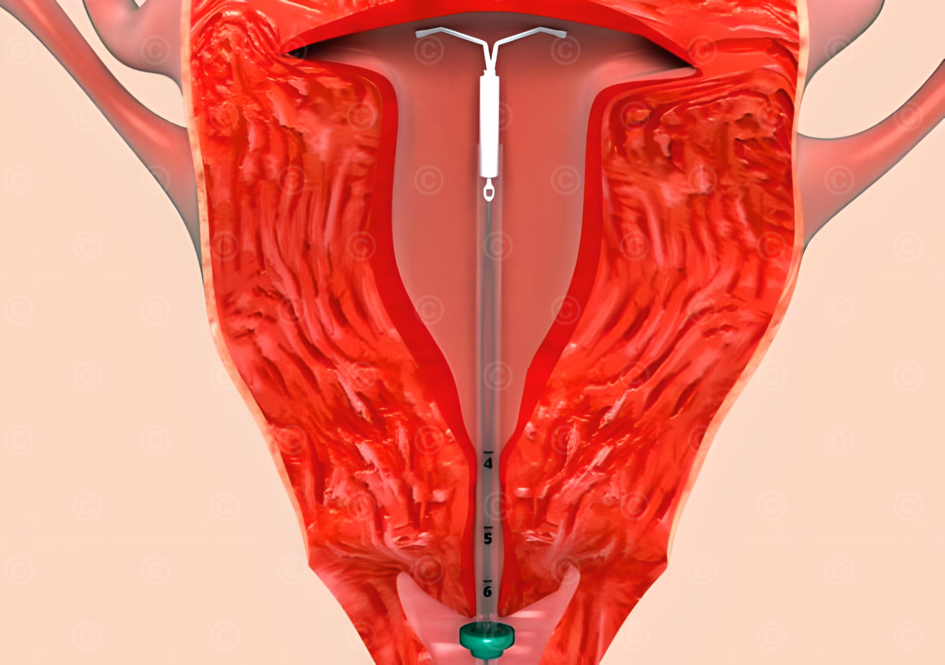 Utilization intrauterine device