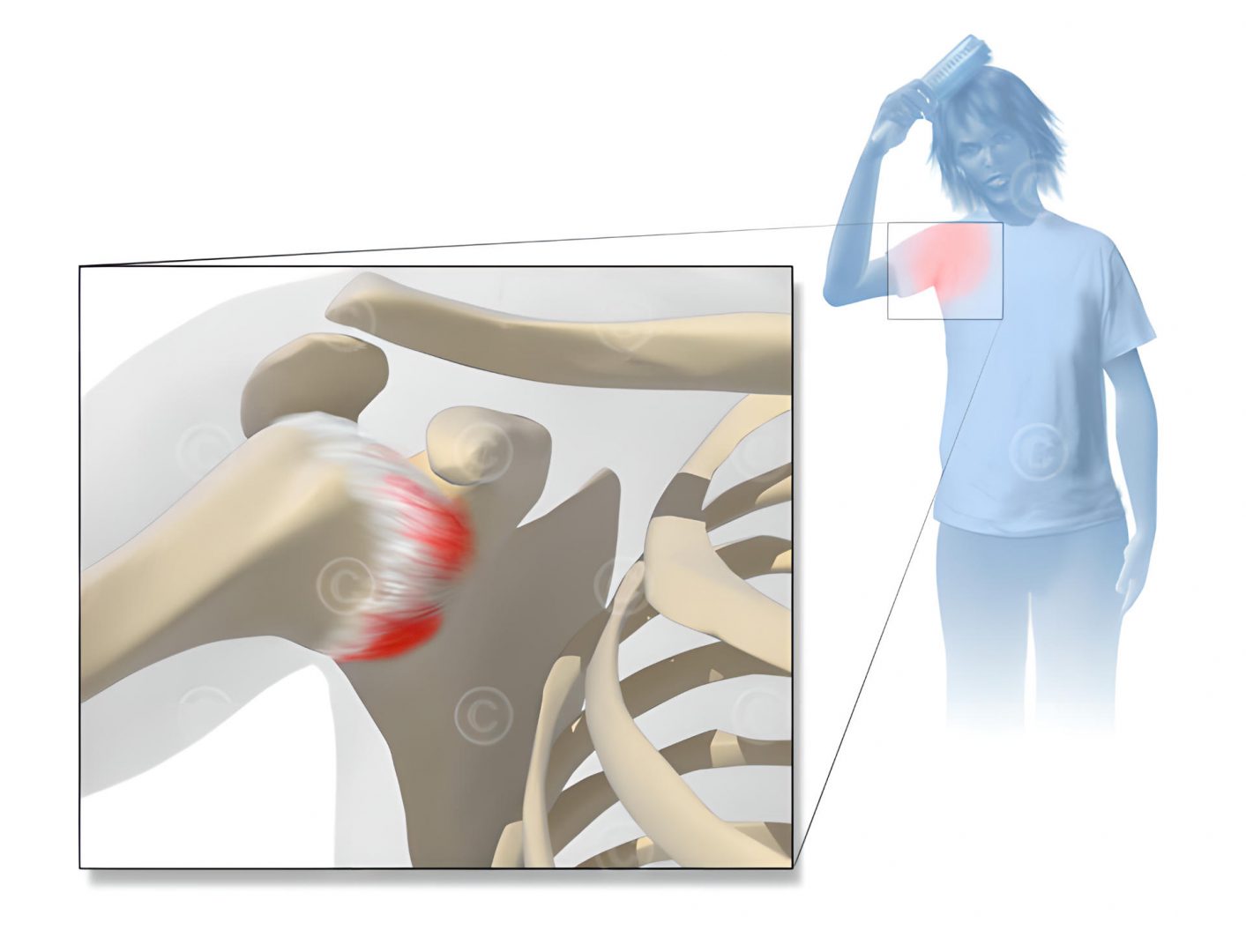 FrozenShoulder medical illustration MedicalGraphics
