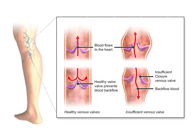 Varicose veins