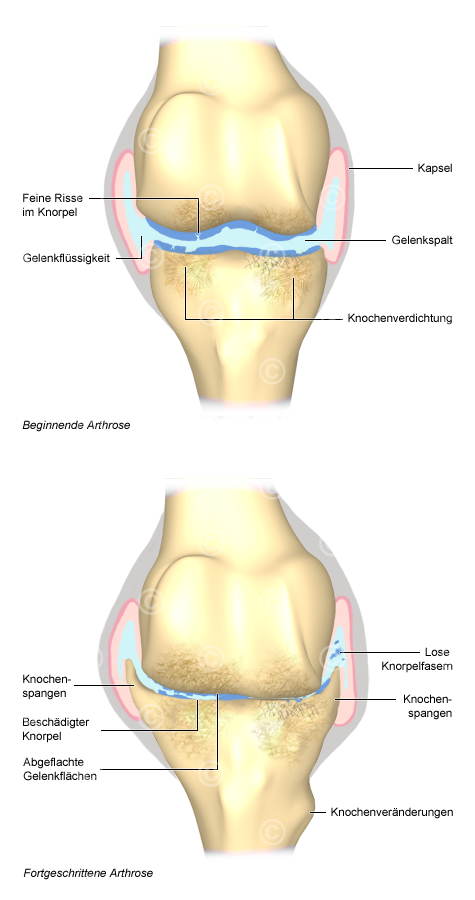 Arthose Knie