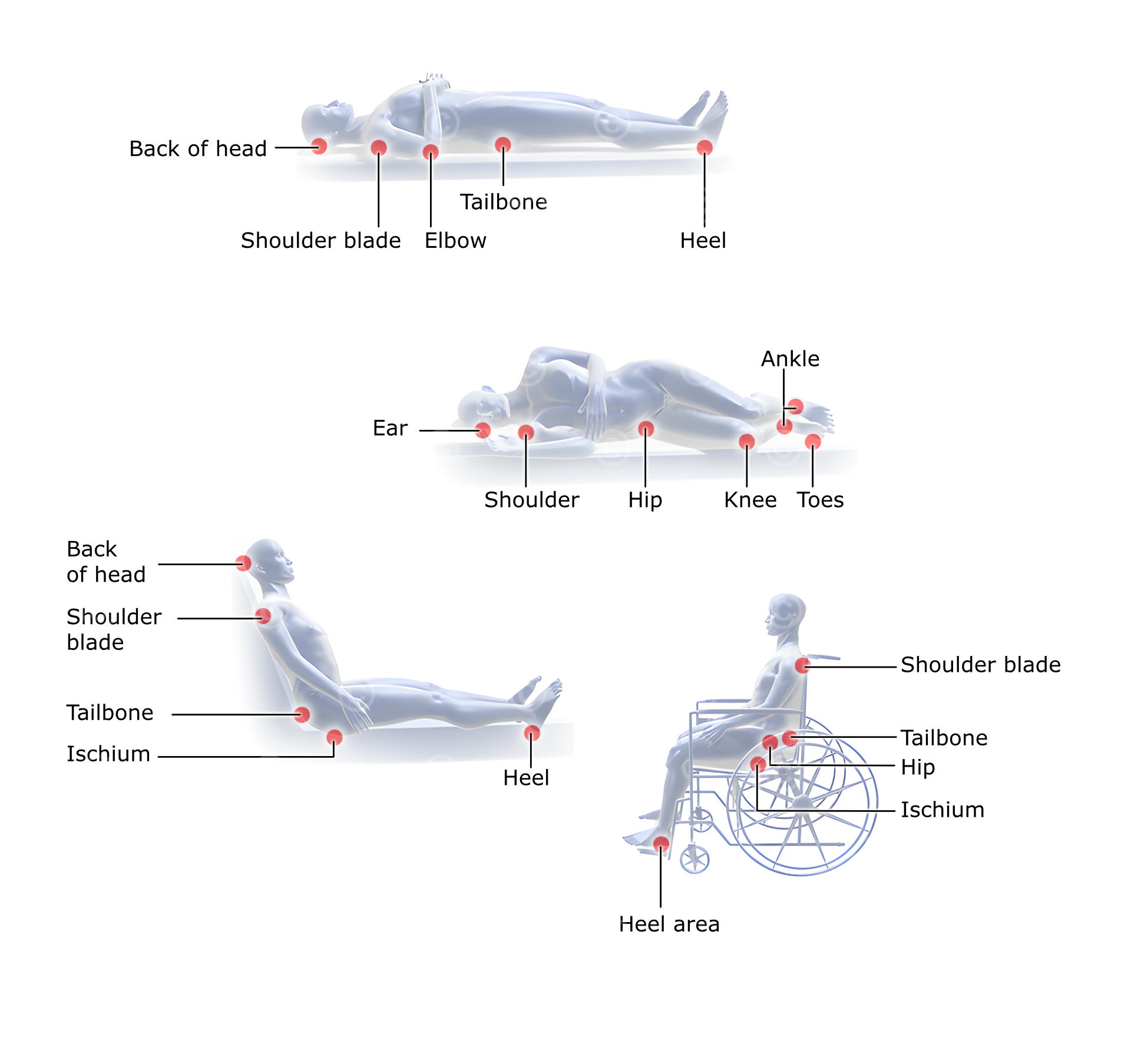 Pressure ulcer