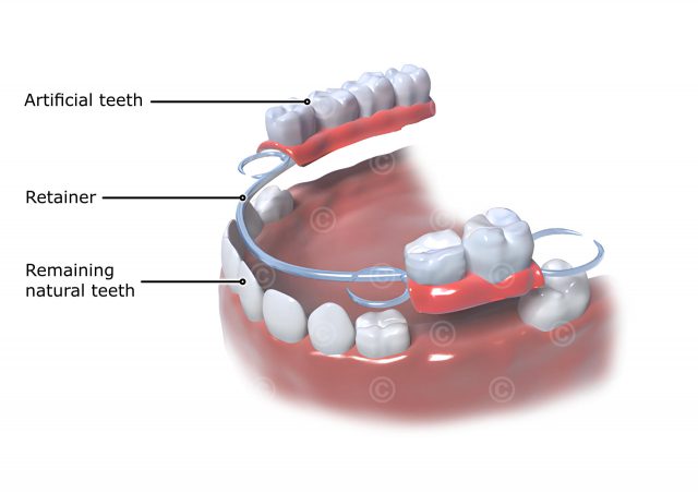 Partial denture
