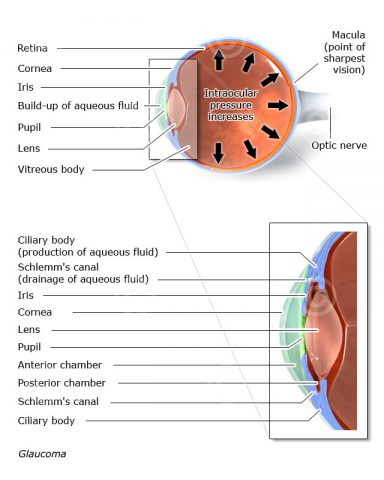 Illustration glaucoma