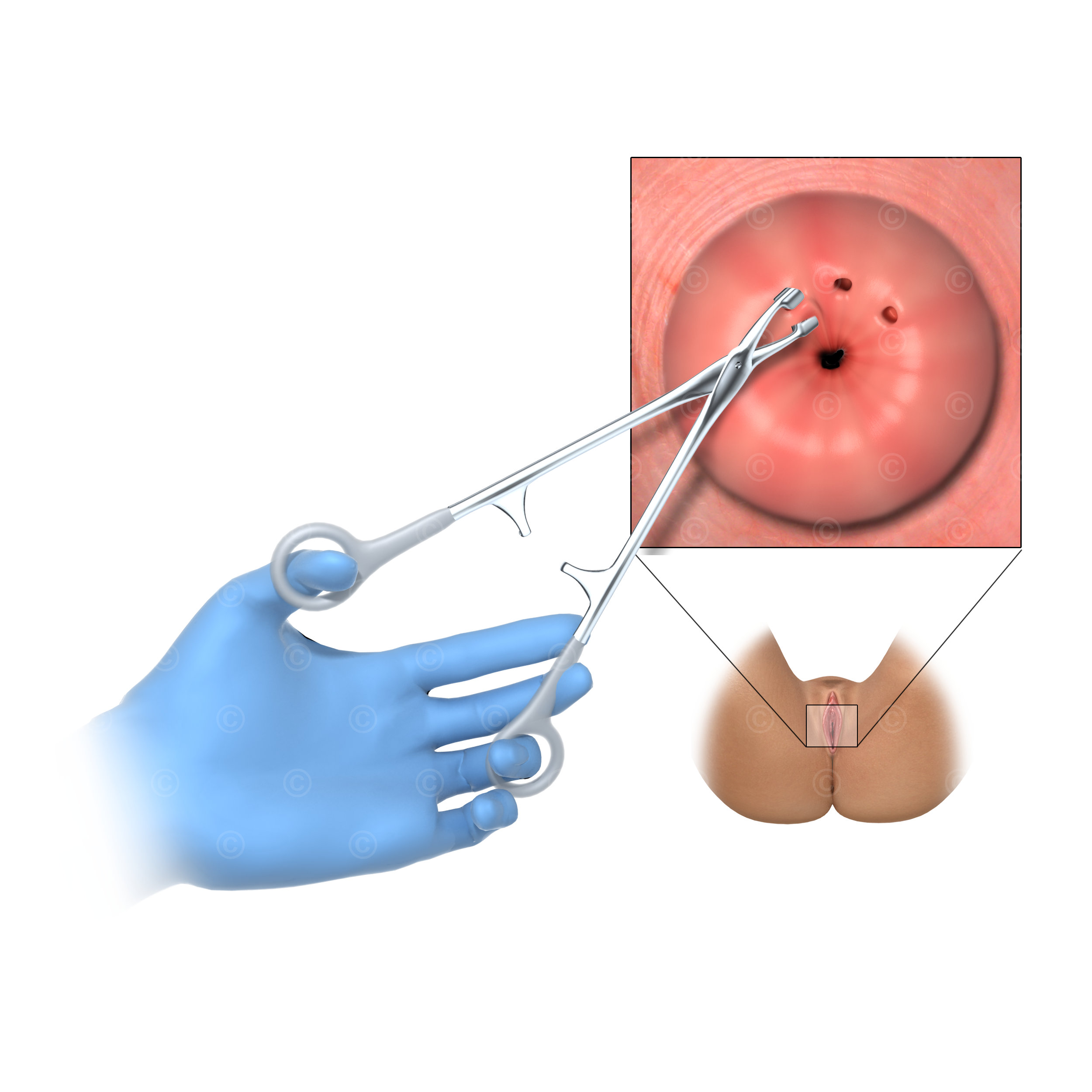 biopsy muttermund