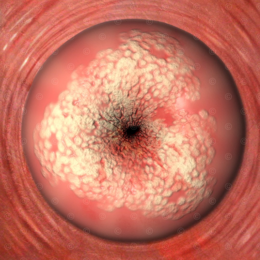 gebaermutterhalskrebs cervix cancer