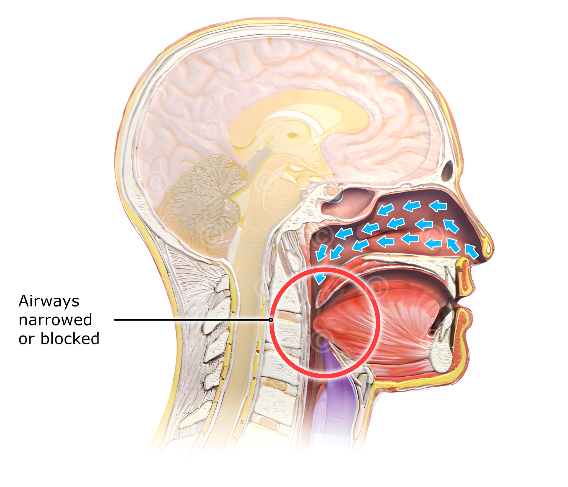 Sleep apnea