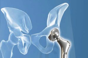 Illustrationen orthopädische Implantate