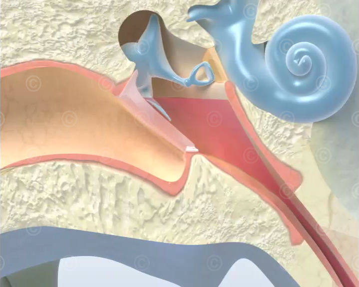 Otitis media with effusion Otitis media with effusion