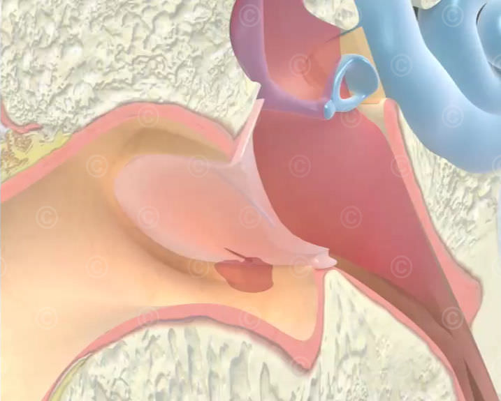 Graphic rupture of the eardrum