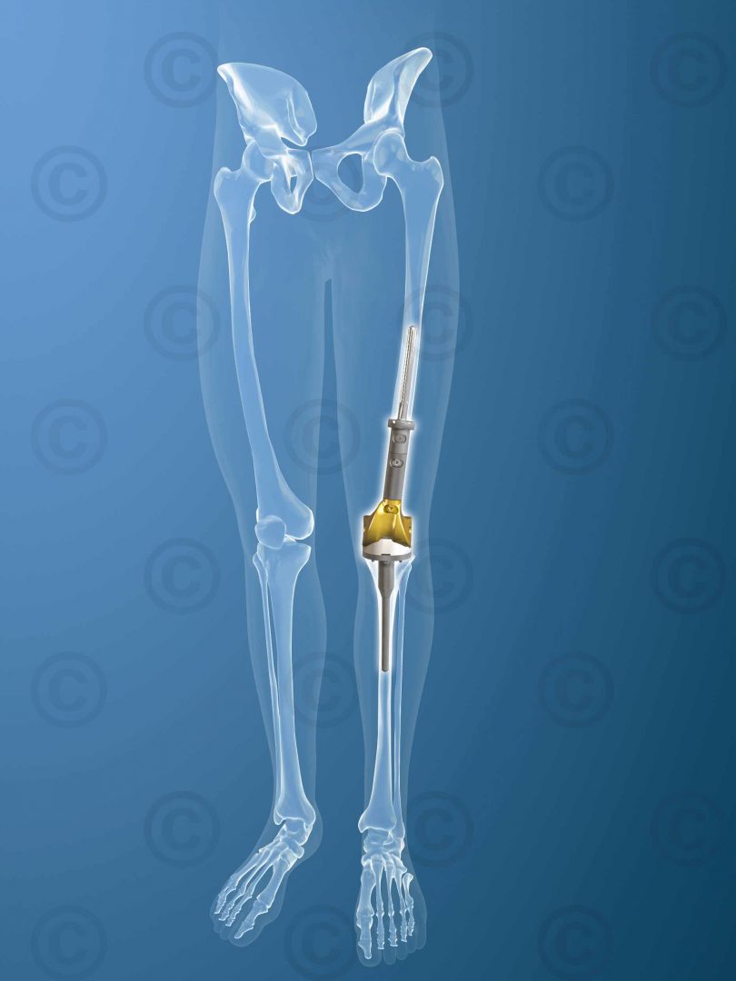 Distale-femur-implant-Tibia