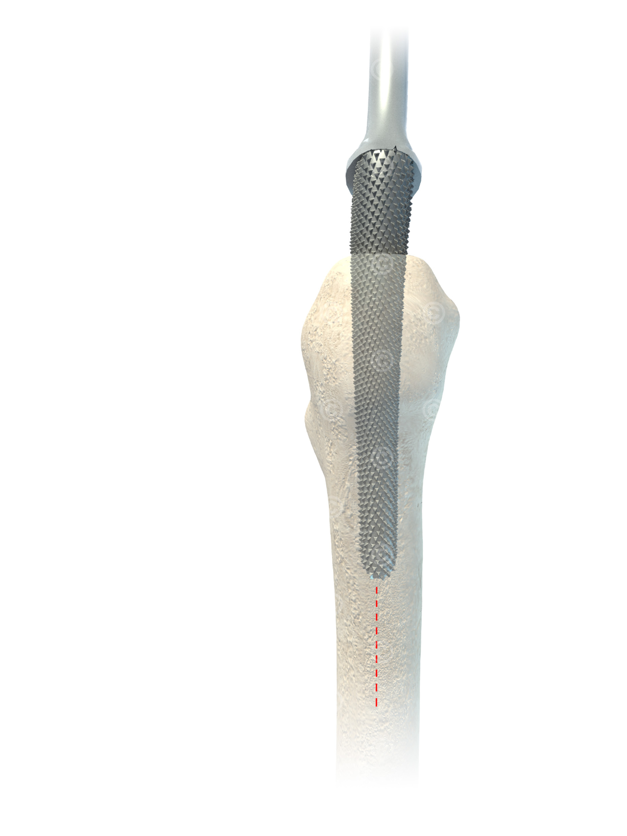 From rasp for preparing the femur for the implant