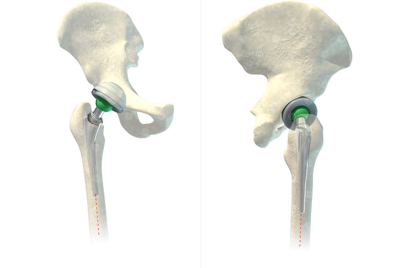 Finished operation result Hip implant consisting of acetabular implant, femoral head, inlay and hip stem