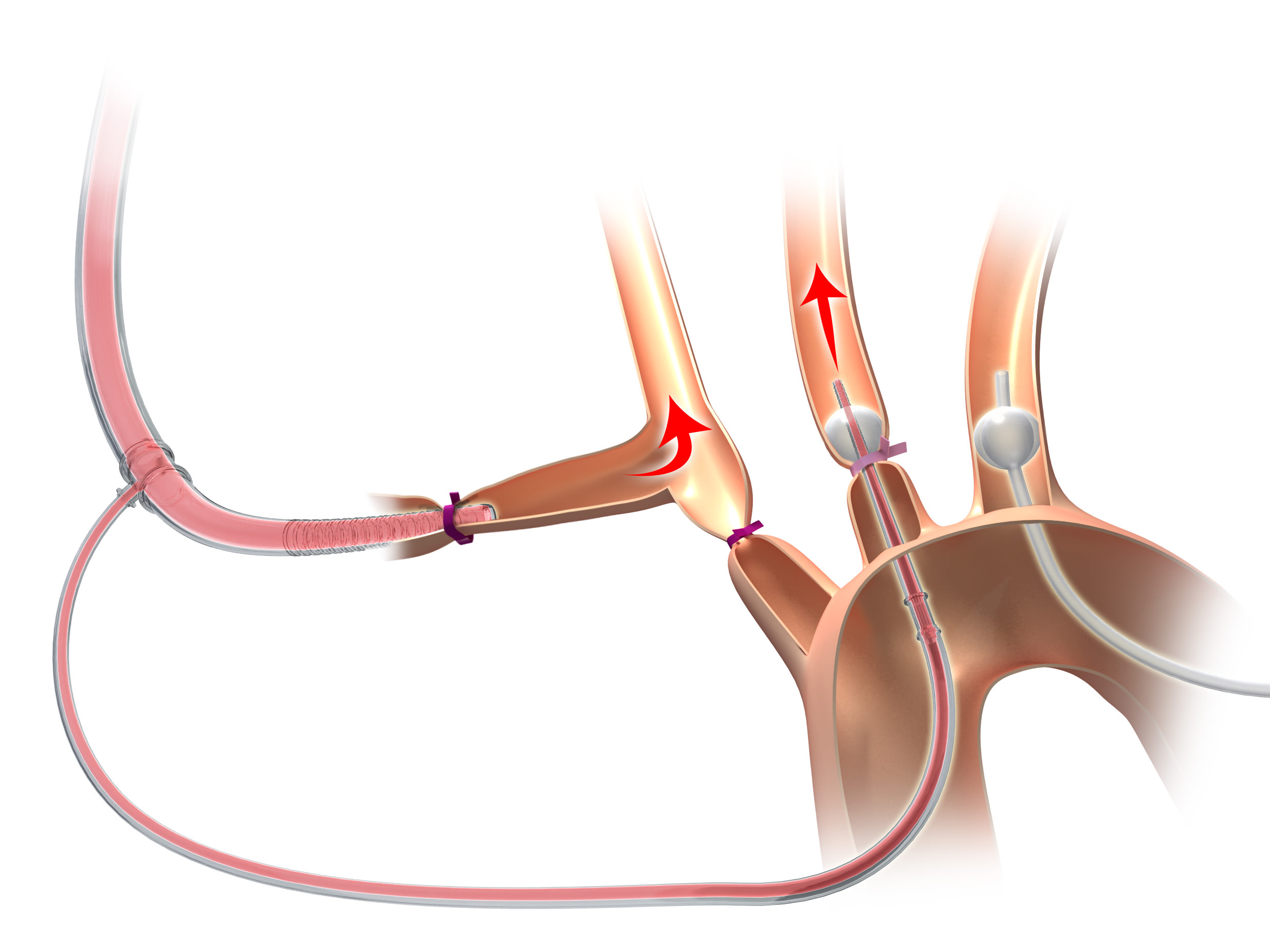 Perfusionskatheter Aortenbogen