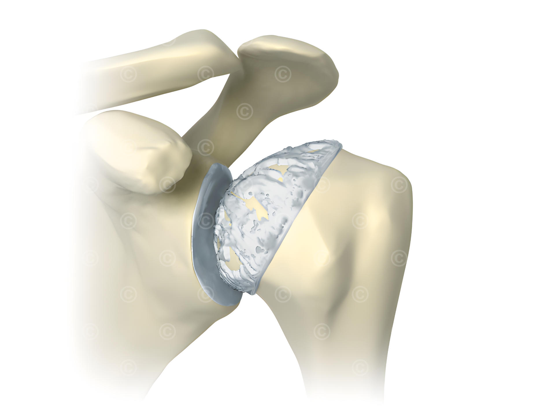 Arthritis shoulder