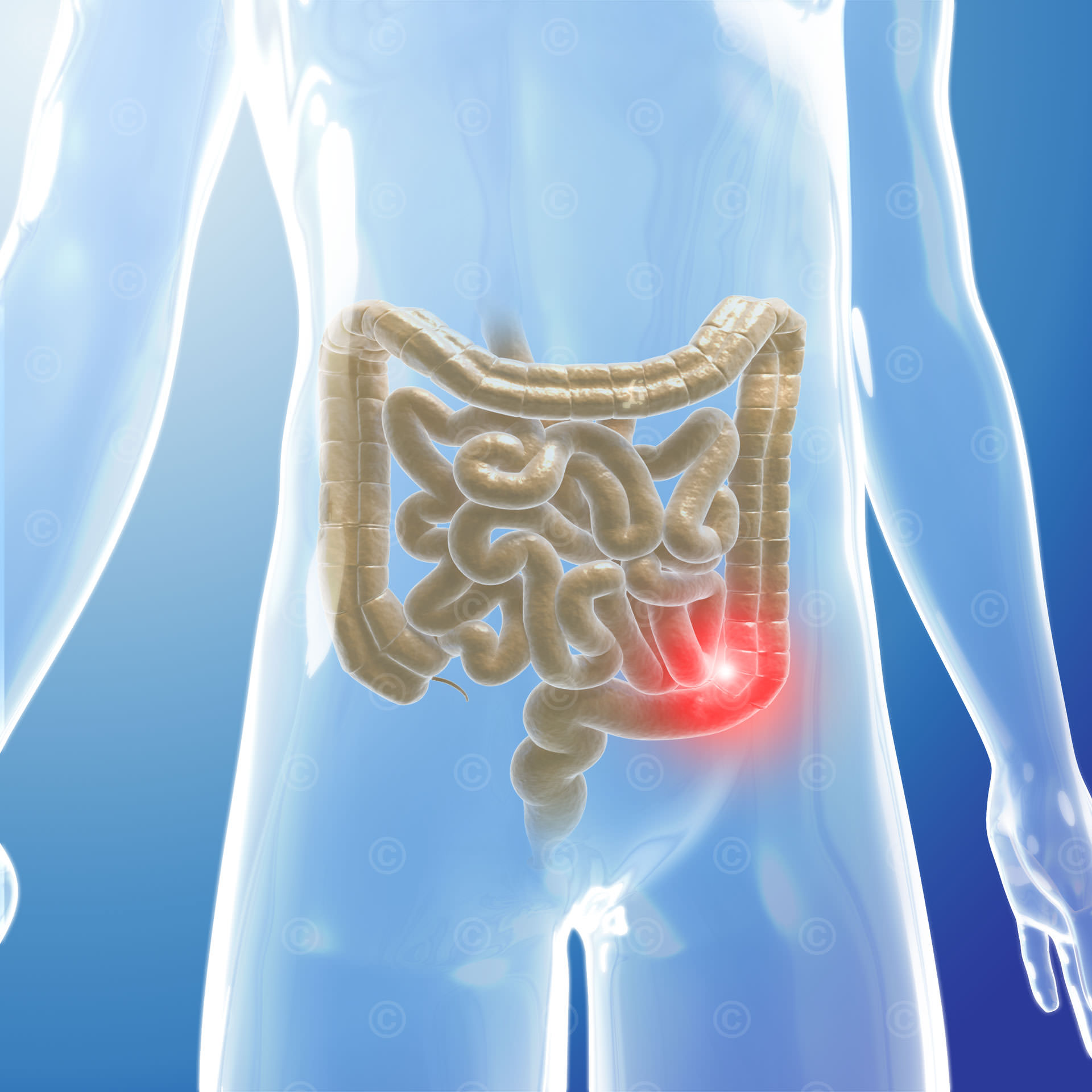 Gastrointestinal stromal tumor