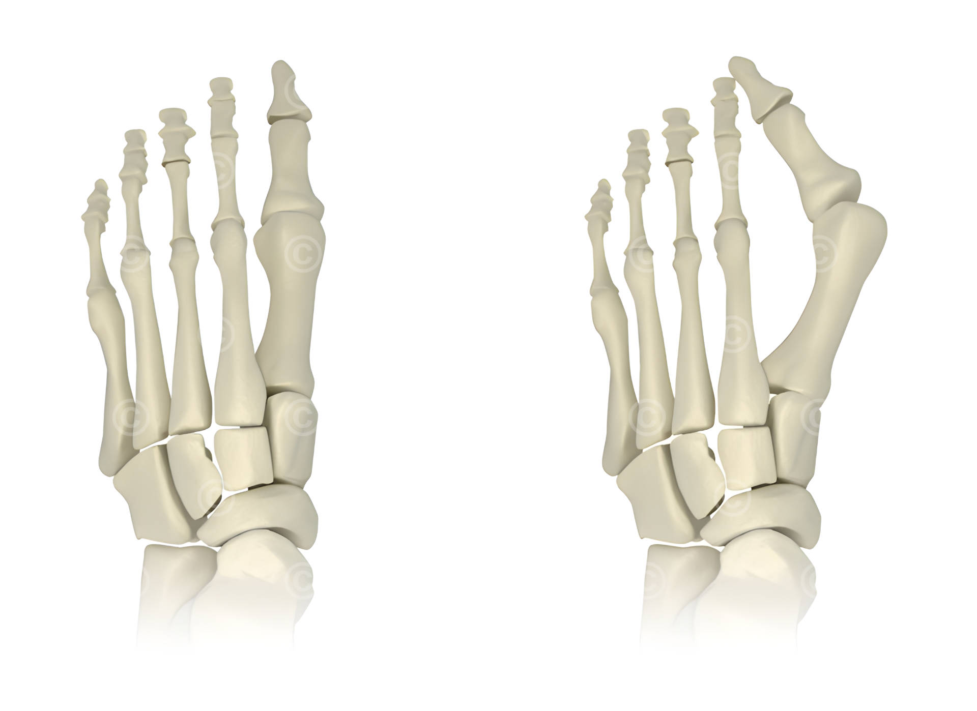 Hallux Valgus