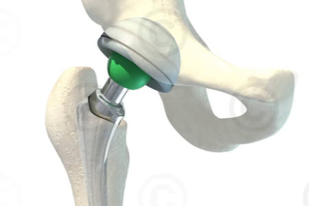 Orthopedic surgical guide