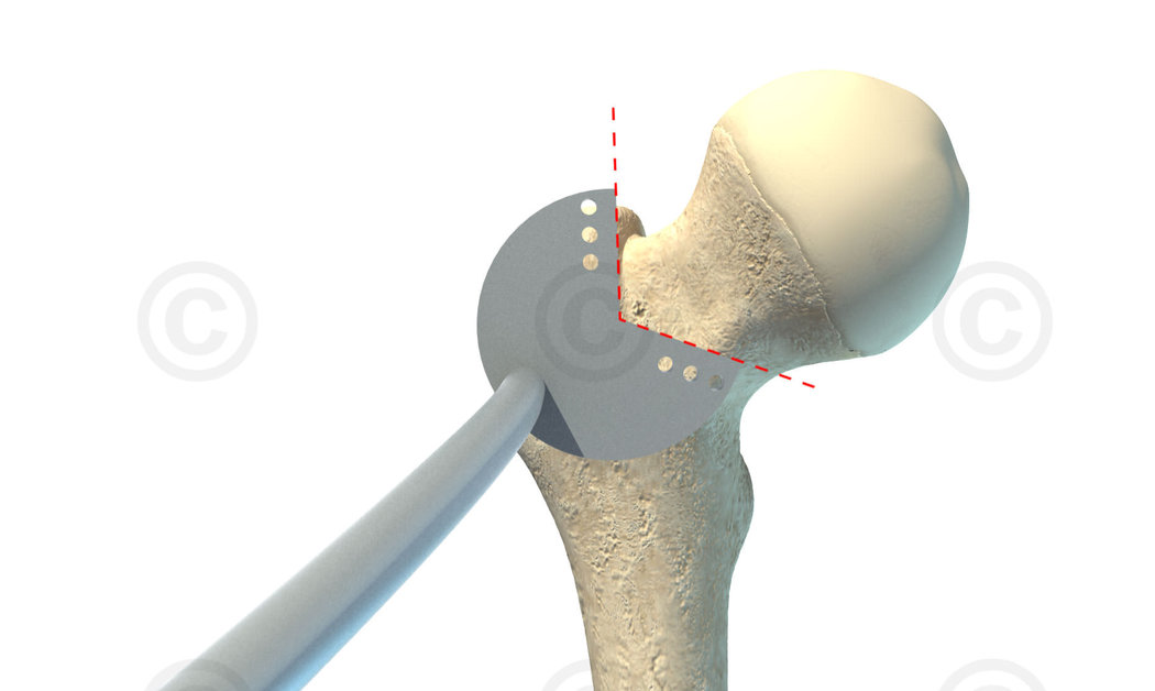 Resektionslehre femur med