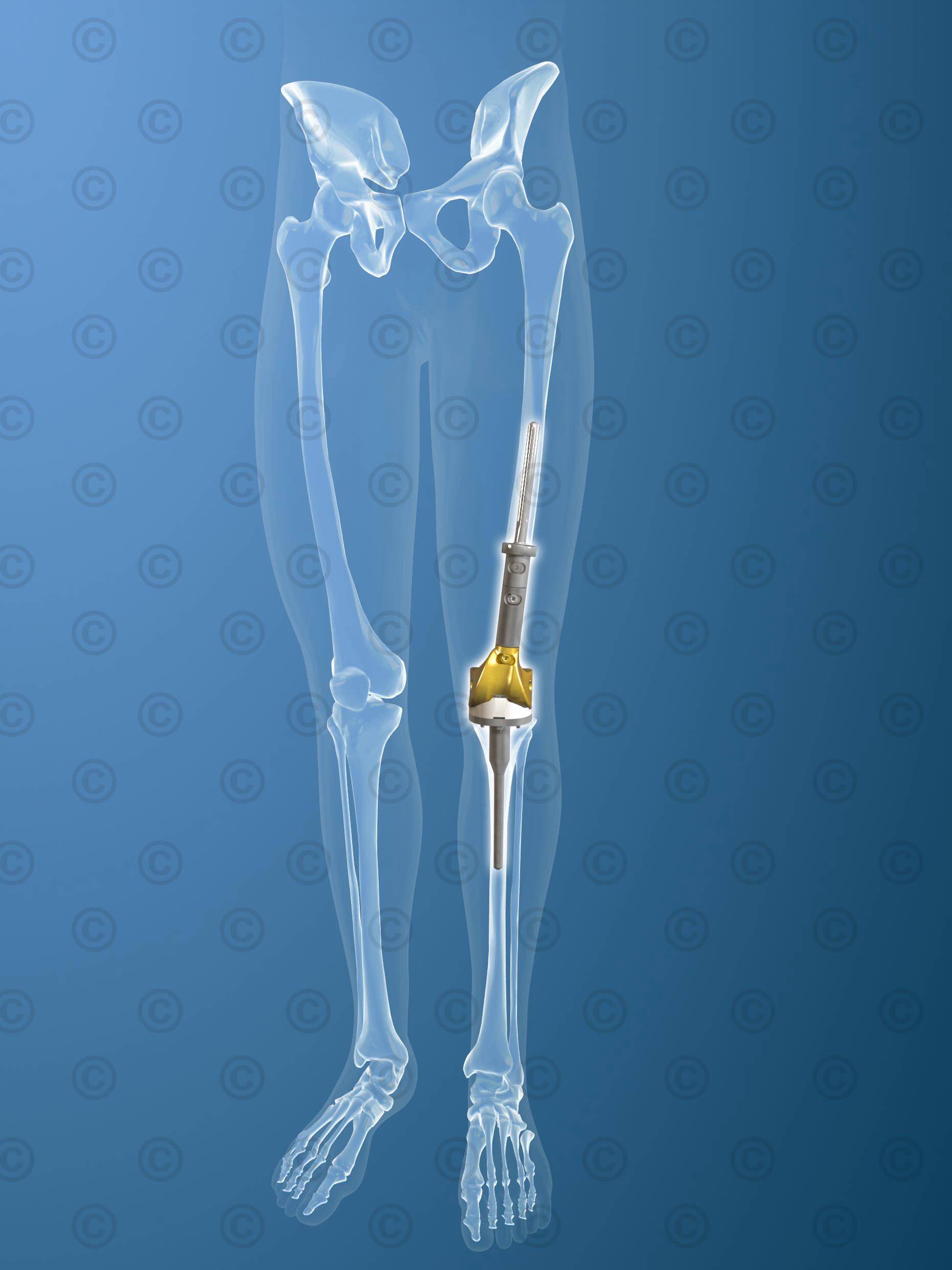 Knee joint replacement