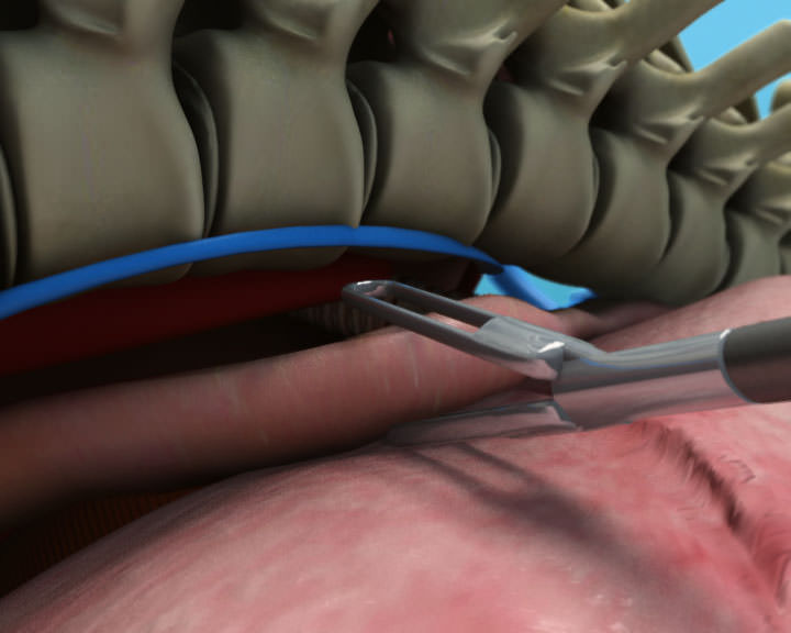 Mobilization esophagus