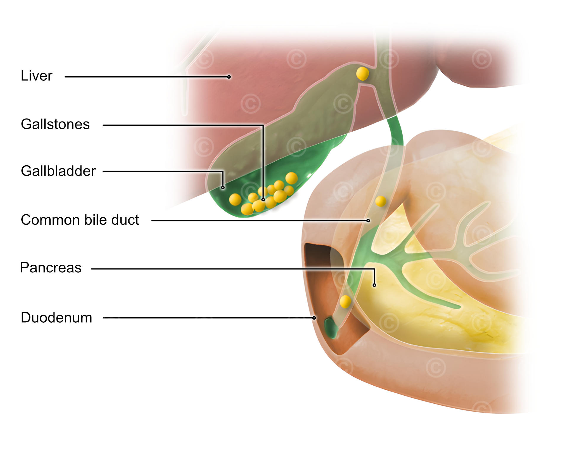 gallstones