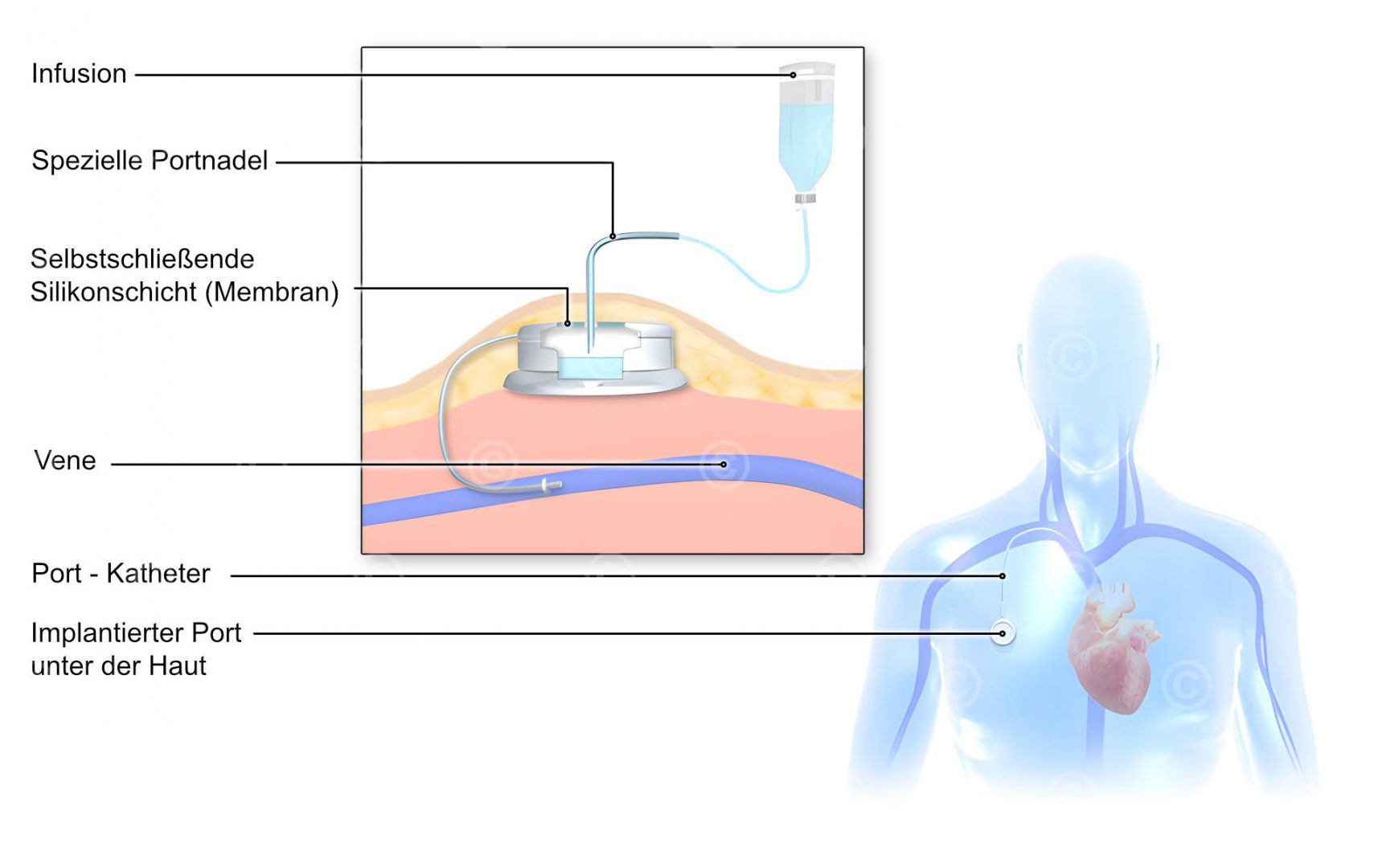 Illustration Portkatheter MedicalGraphics
