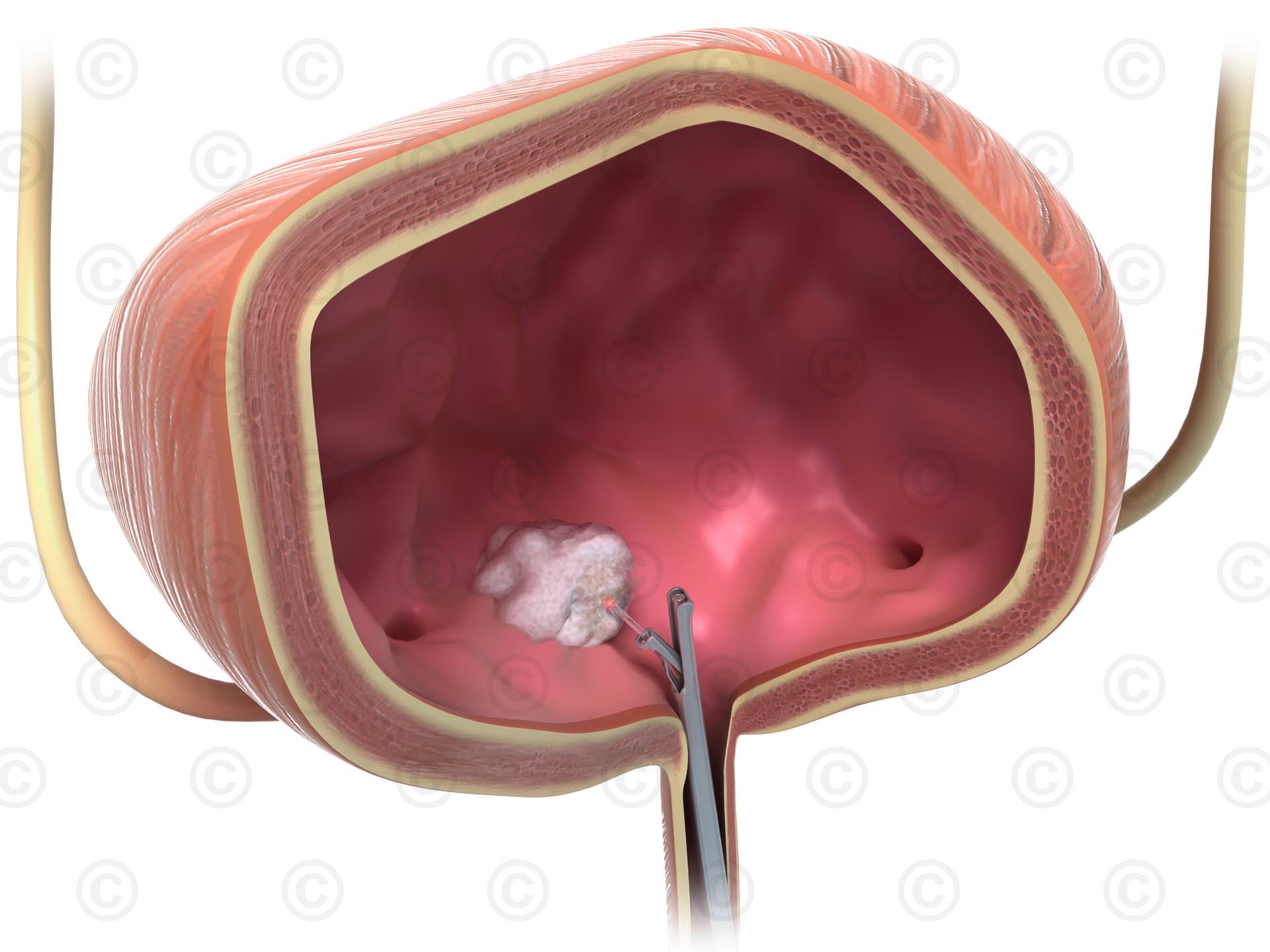 treatment-bladder-cancer