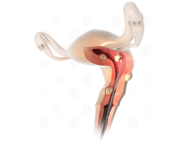Illustration pathological changes uterus