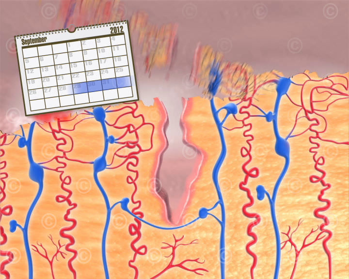 Detachment of the endometrium during menstruation