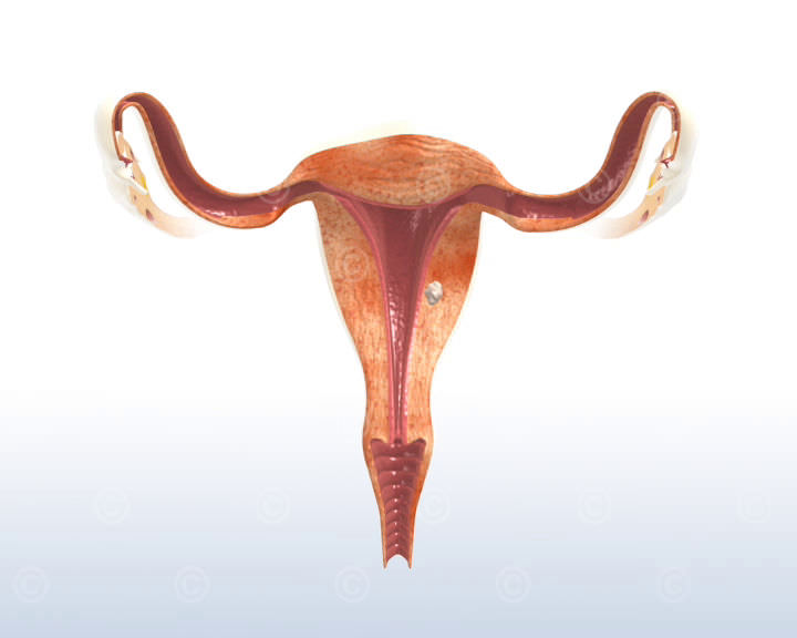 beschwerden monatblutung myom Myomas complaints menstruation