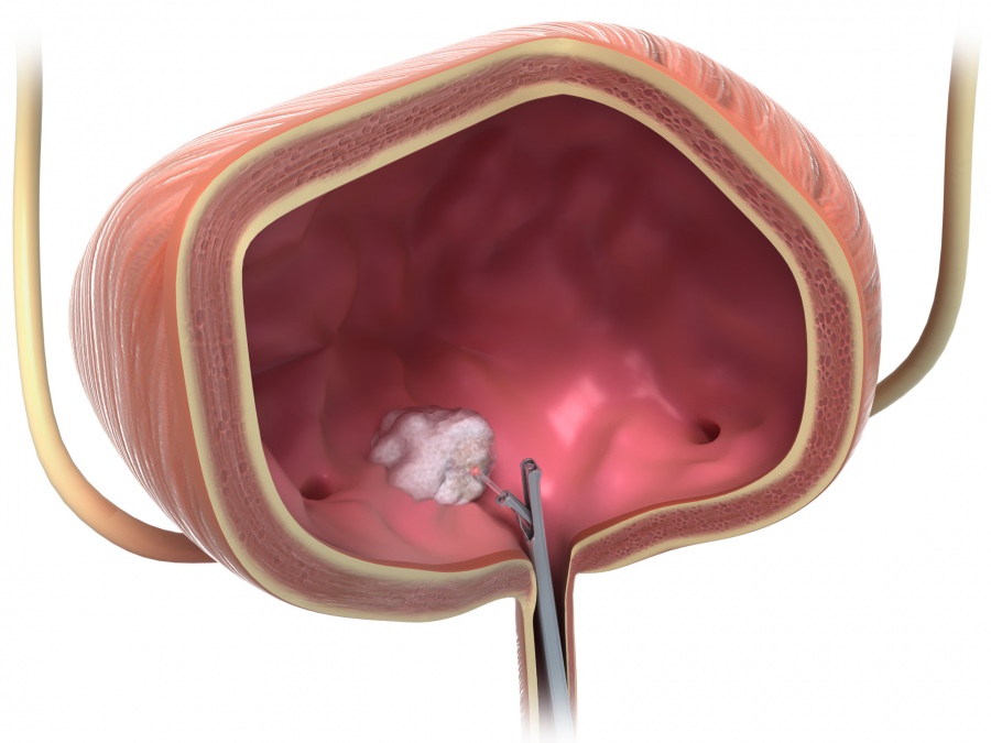 Laser surgery bladder cancer