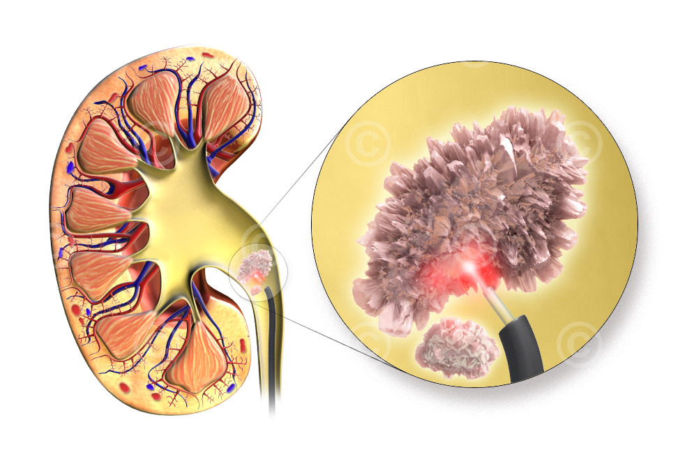 Urolithiasis - Laser fiber