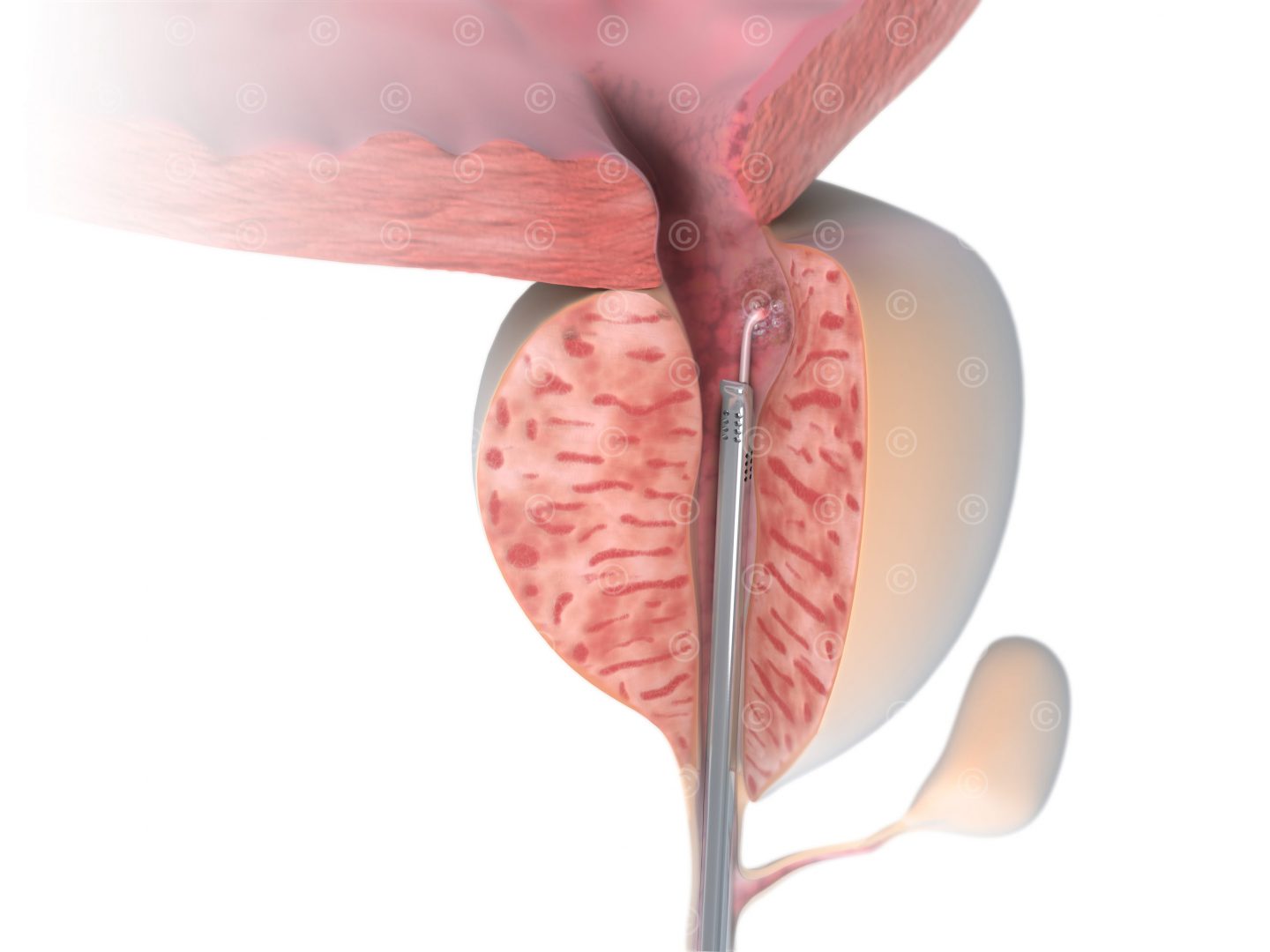 Surgery enlarged prostate