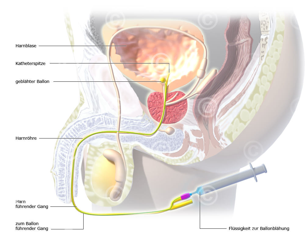 Urinary catheter - male patient