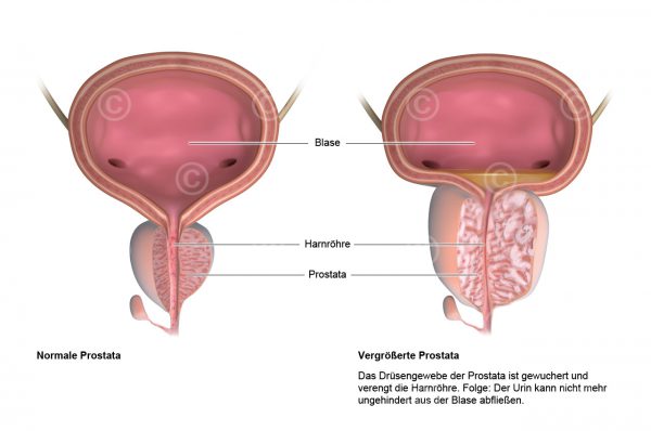Illustration Vergrößerte Prostata - MedicalGraphics
