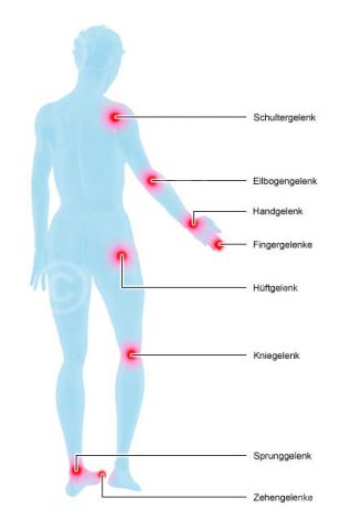 Ilustration regions of rheumatism - MedicalGraphics