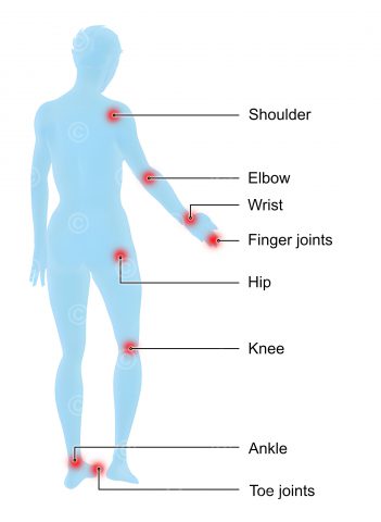 Regions rheumatism