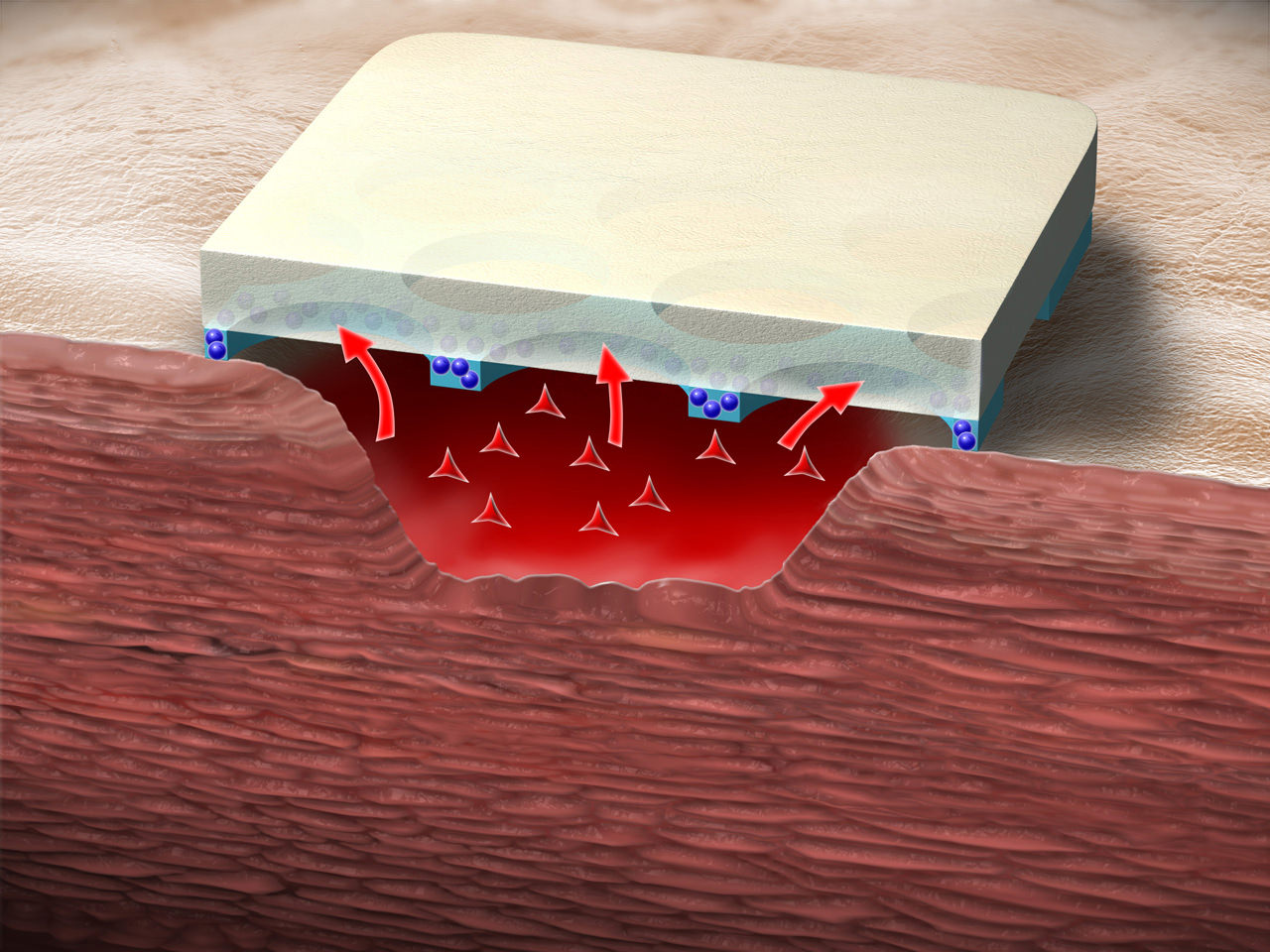 Storage of exudate in wound dressing HydroTac