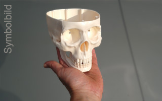 3D printing occlusion of the pulmonary artery